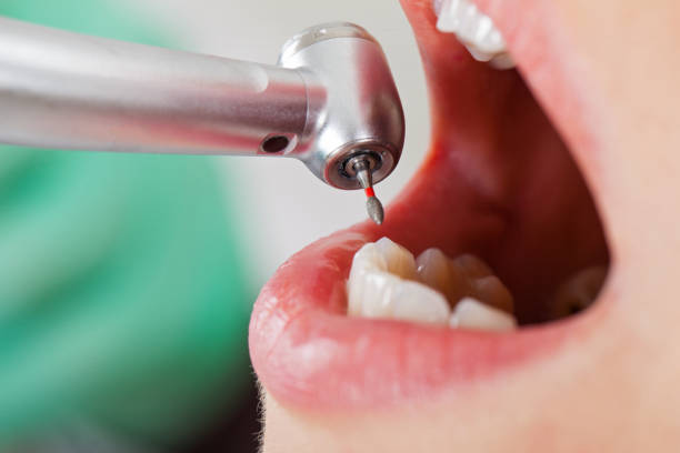 Best Emergency Tooth Extraction in Concord, MO